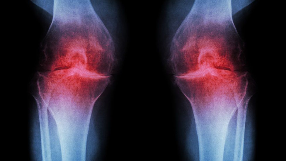 How Does The Device Help With Arthritis?